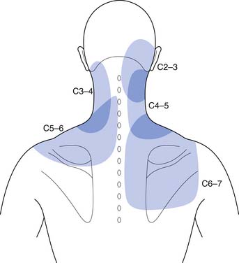 The typical localization of reflected neck pain from the facet joints of the cervical spine.